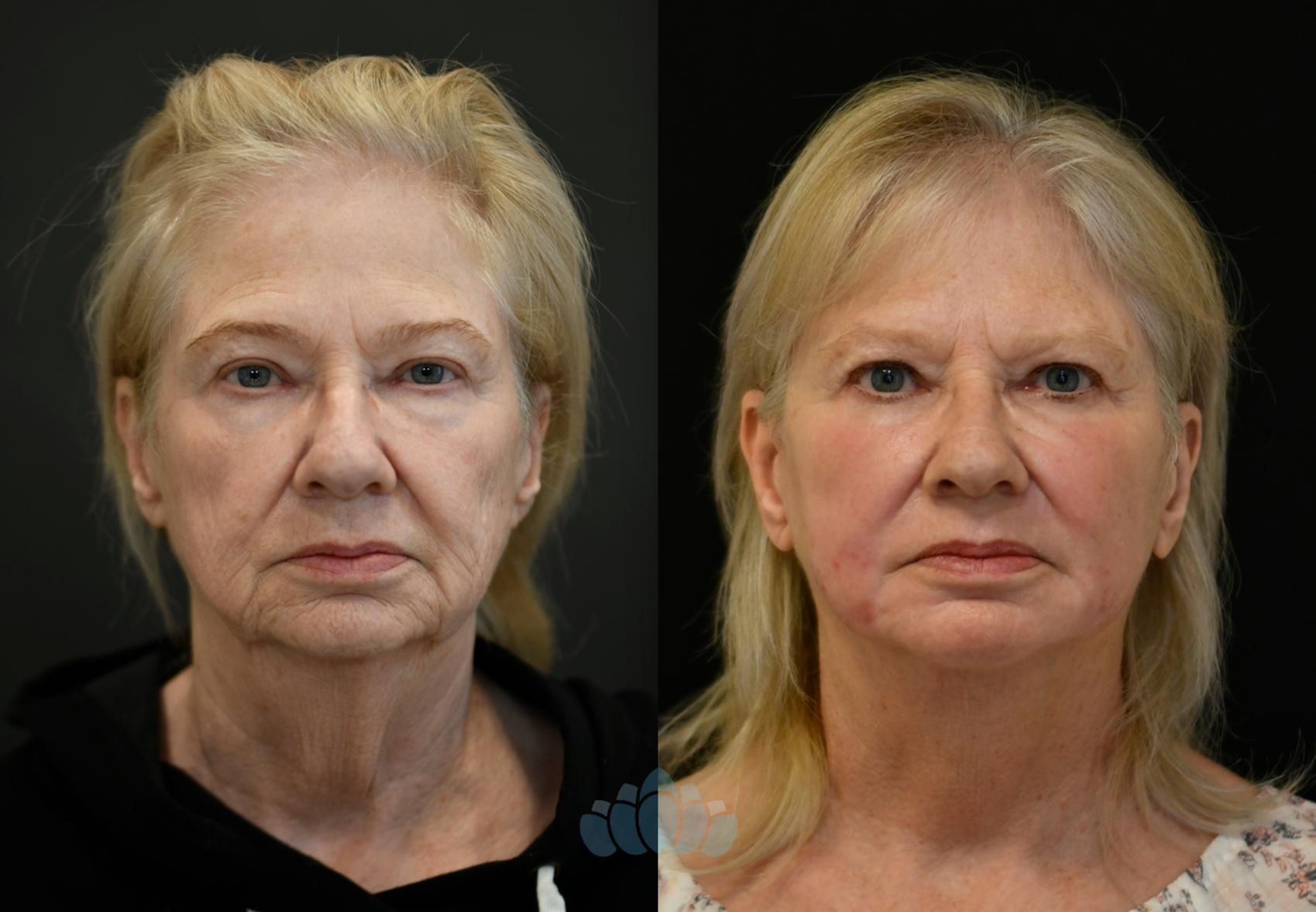 Before & After Facelift Case 114 Front View in Charlotte, NC