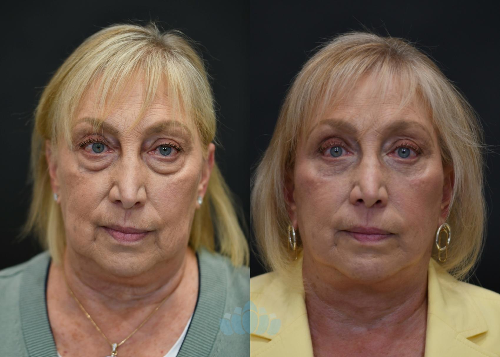 Before & After Facelift Case 116 Front View in Charlotte, NC