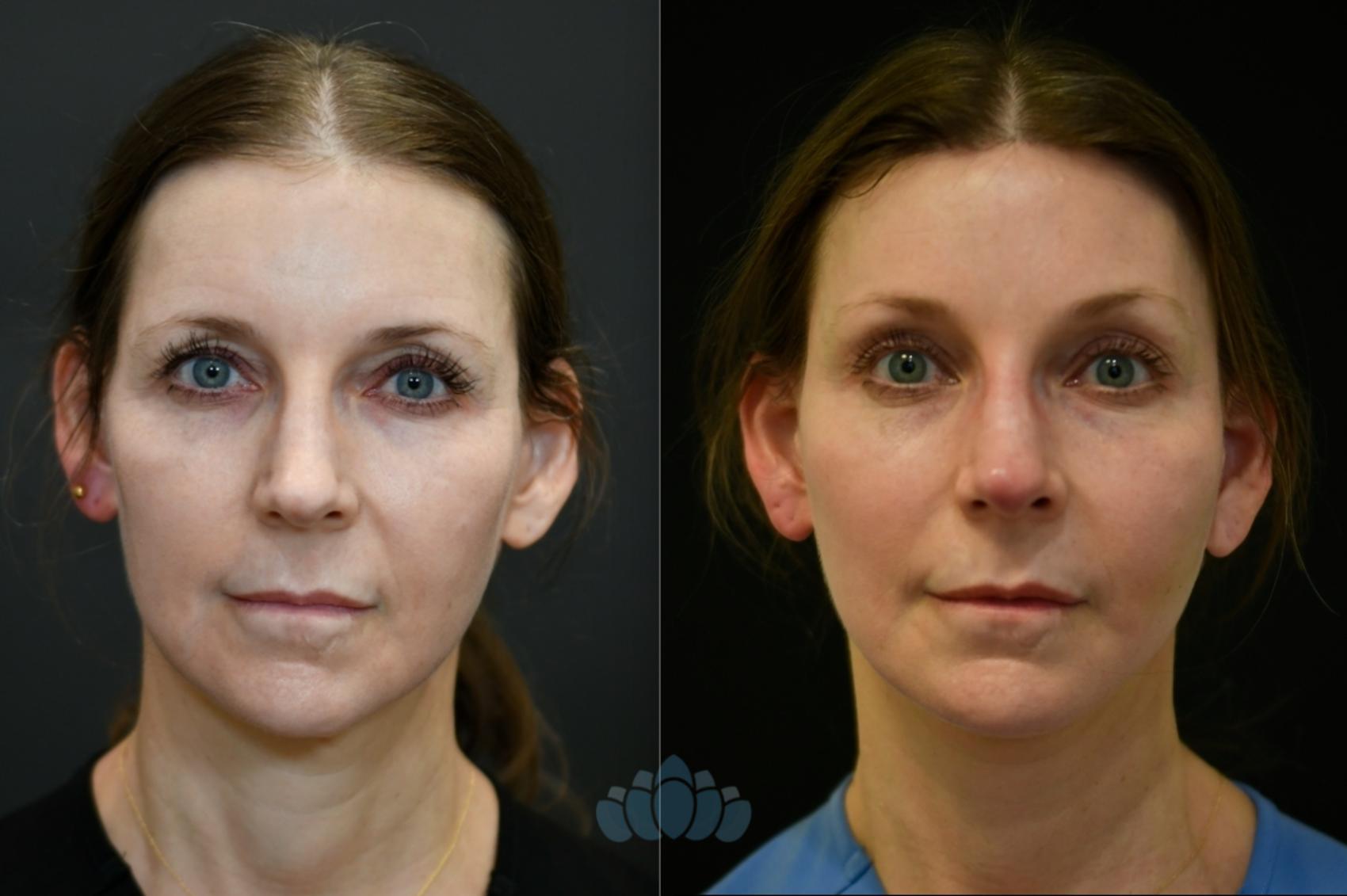 Before & After Brow Lift Case 117 Front View in Charlotte, NC