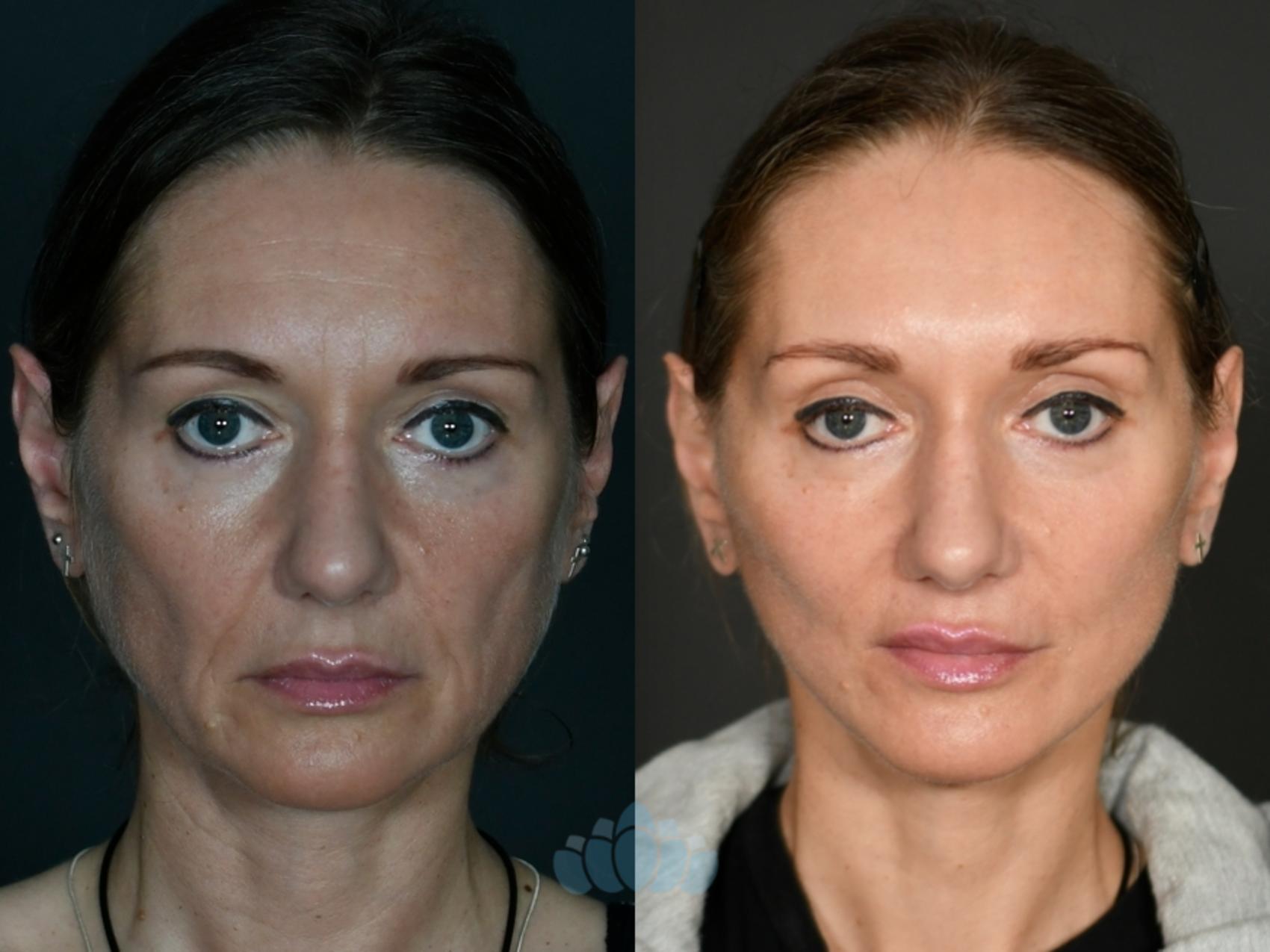 Before & After Facelift Case 119 Front View in Charlotte, NC