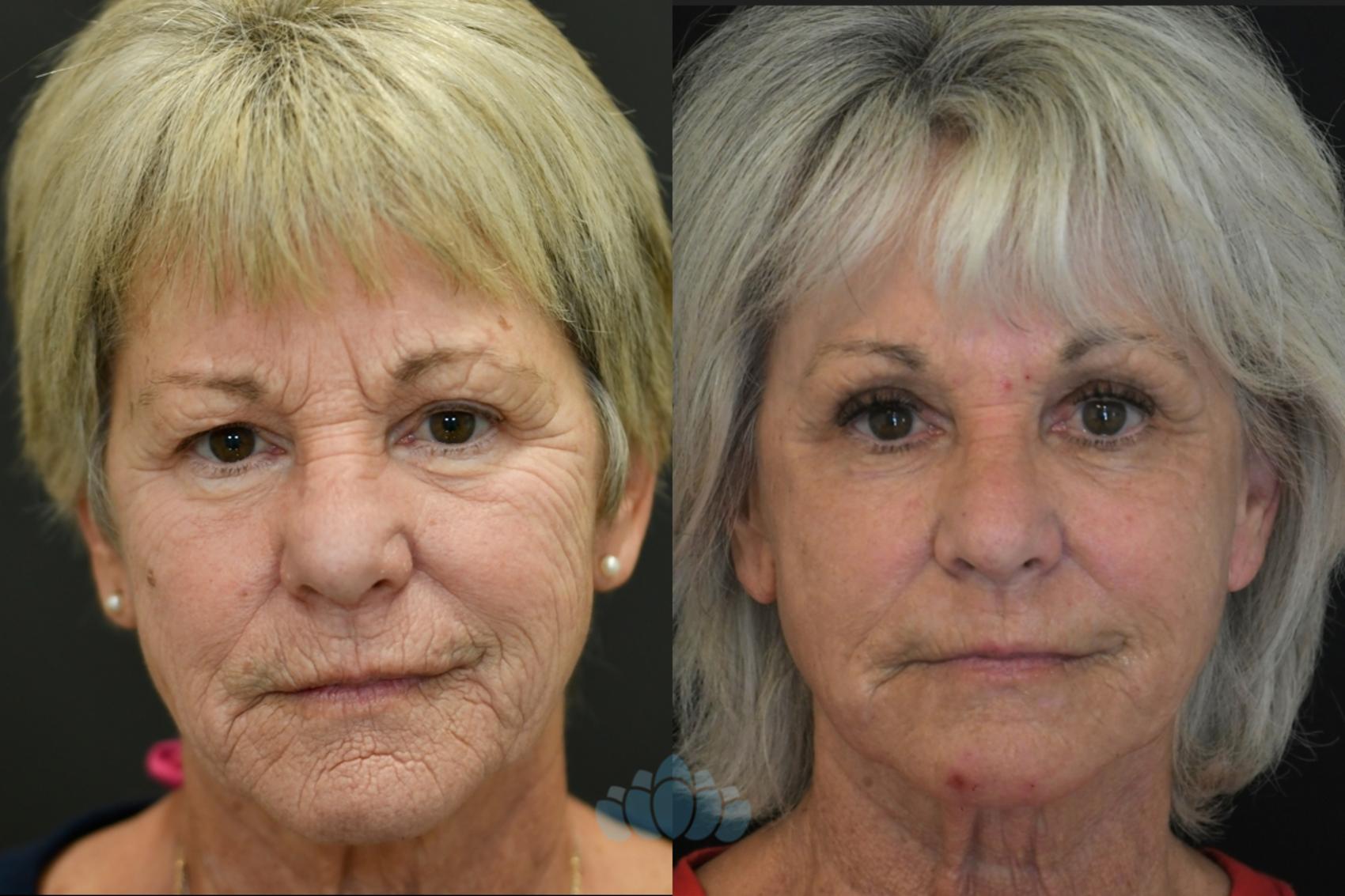 Before & After Laser resurfacing Case 124 Front View in Charlotte, NC