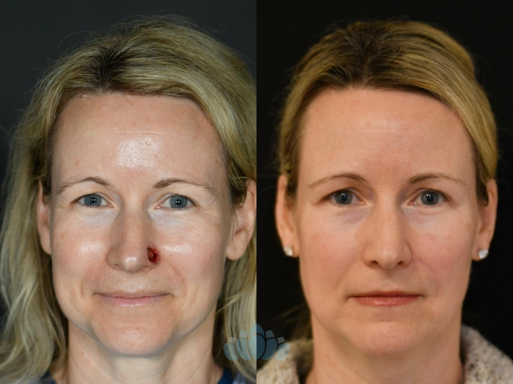 Before & After Mohs & Skin Cancer Surgery Case 118 Front View in Charlotte, NC