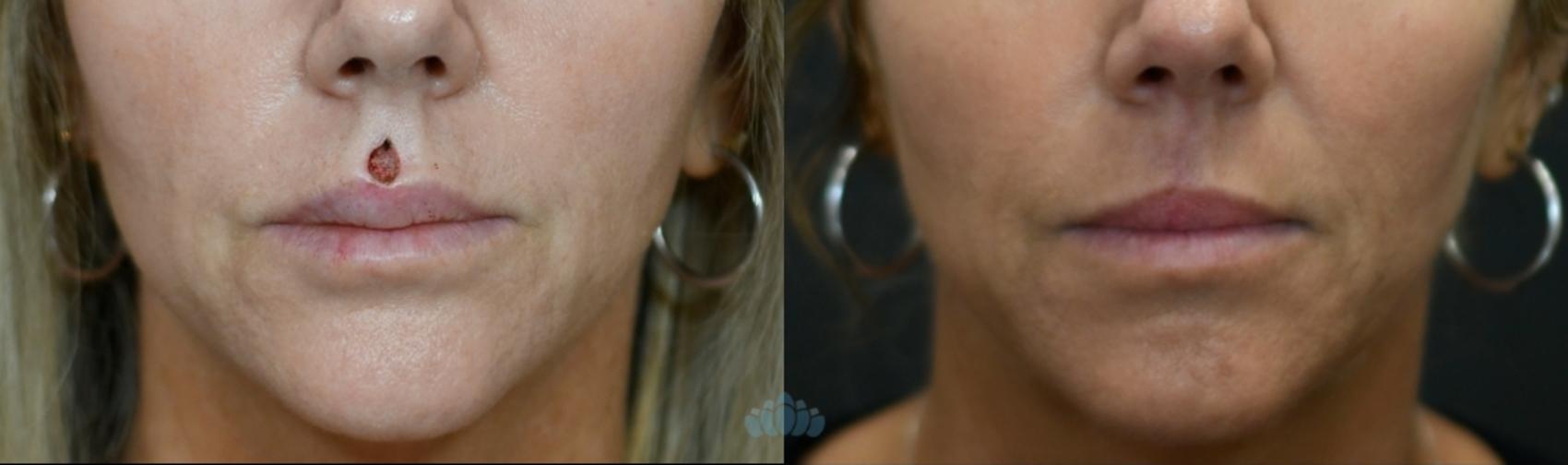 Before & After Mohs & Skin Cancer Surgery Case 120 Front View in Charlotte, NC