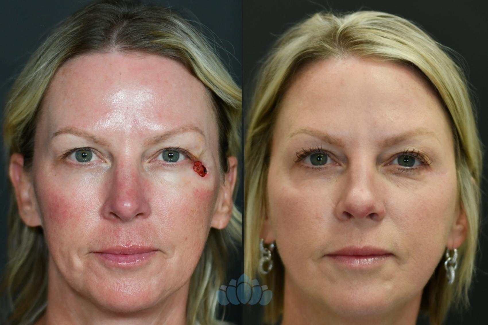 Before & After Mohs & Skin Cancer Surgery Case 121 Front View in Charlotte, NC