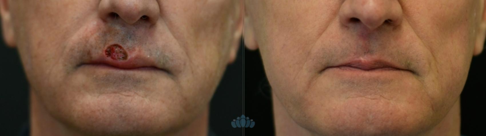 Before & After Mohs & Skin Cancer Surgery Case 122 Front View in Charlotte, NC
