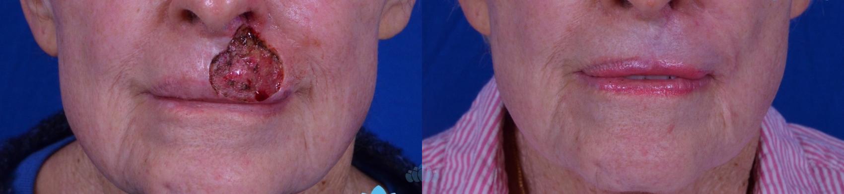 Before & After Skin Cancer Reconstruction after Mohs Surgery Case 21 Front View in Charlotte, NC