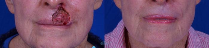 Before & After Skin Cancer Reconstruction after Mohs Surgery Case 21 Front View in Charlotte, NC