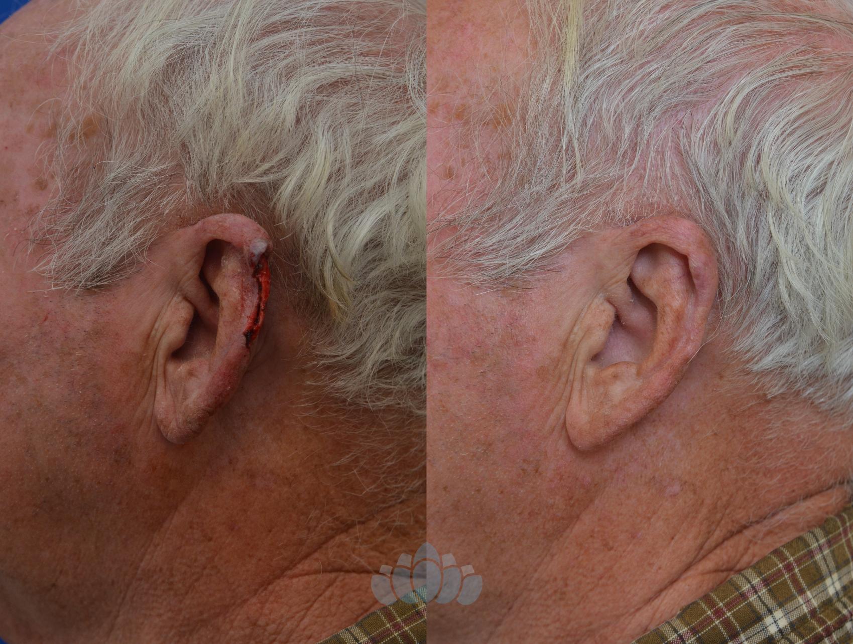 Before & After Skin Cancer Reconstruction after Mohs Surgery Case 5 Left Side View in Charlotte, NC