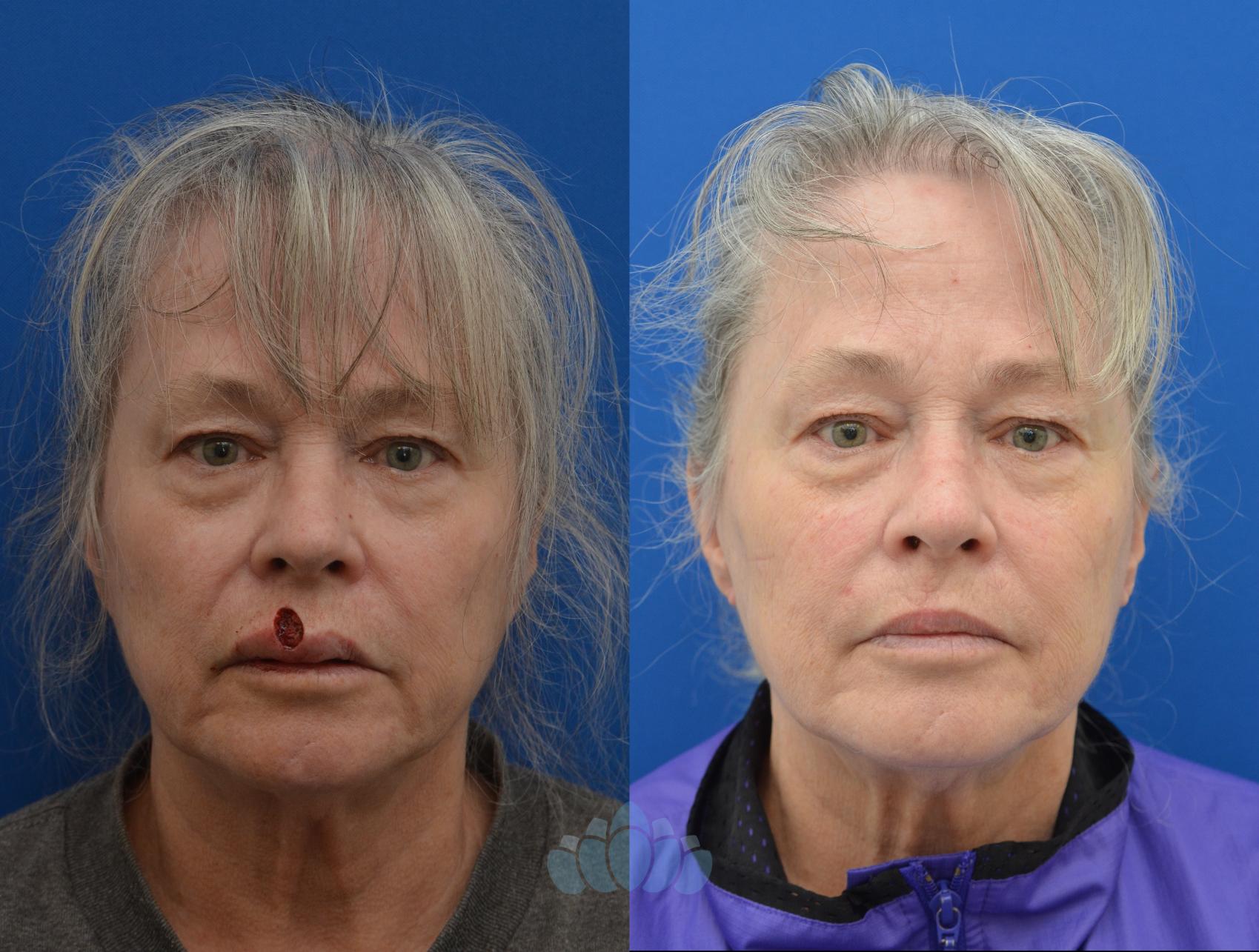 Before & After Skin Cancer Reconstruction after Mohs Surgery Case 6 Front View in Charlotte, NC