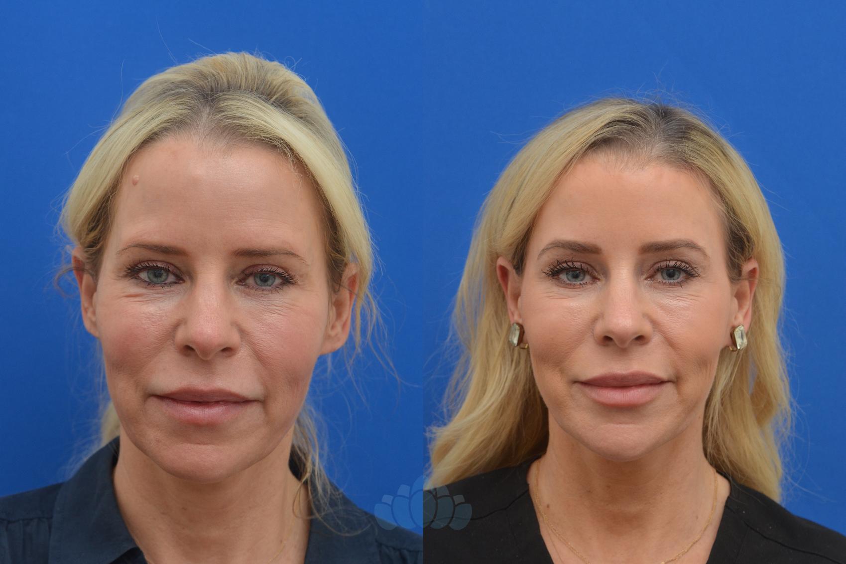 vertaling Wanneer Vanaf daar Brow Lift Before and After Photo Gallery | Charlotte, NC | Dilworth Facial  Plastic Surgery