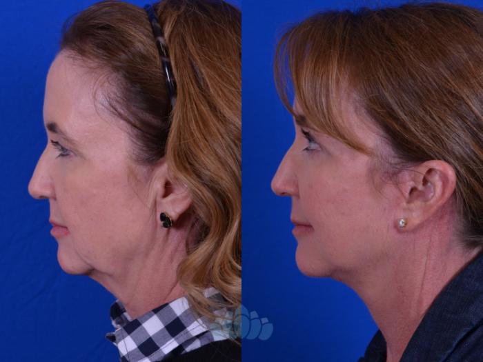 Deep Plane Face Lift