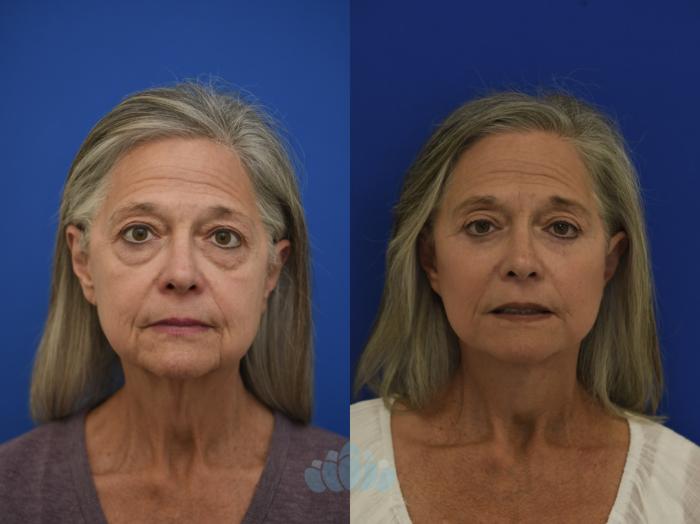 63 year old female before lower eyelid surgery and deep plane facelift surgery