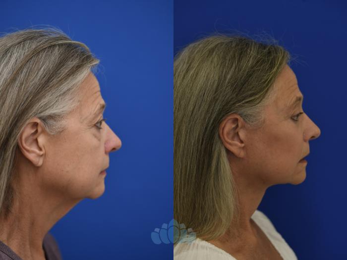 63 year old female before lower eyelid surgery and deep plane facelift surgery