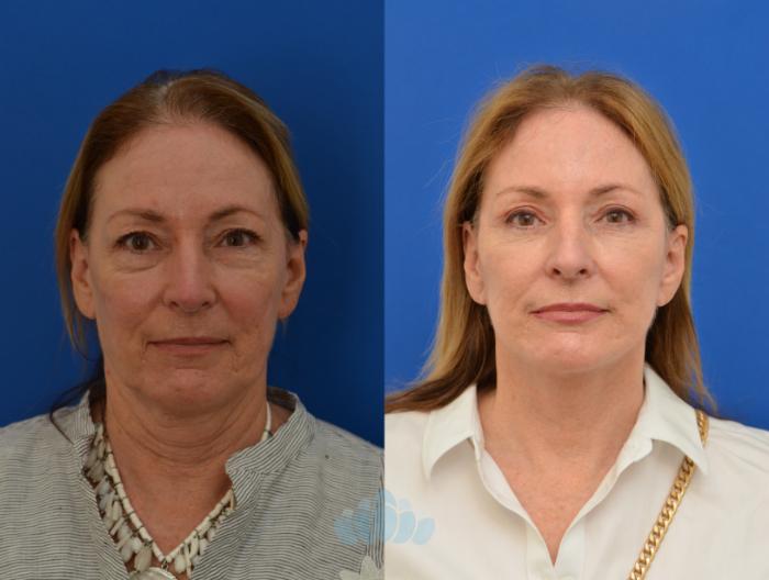 Deep Plane Facelift, Bilateral Upper Blepharoplasty, Bilateral Lower Blepharoplasty - Before 