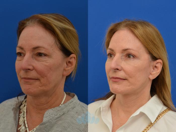 Deep Plane Facelift, Bilateral Upper Blepharoplasty, Bilateral Lower Blepharoplasty - Before