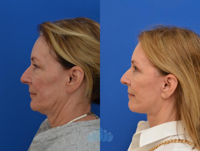 Deep Plane Facelift, Bilateral Upper Blepharoplasty, Bilateral Lower Blepharoplasty - Before