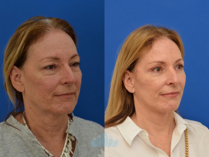 Deep Plane Facelift, Bilateral Upper Blepharoplasty, Bilateral Lower Blepharoplasty - Before 