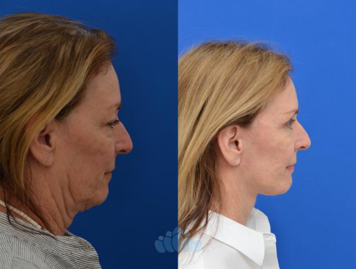 Deep Plane Facelift, Bilateral Upper Blepharoplasty, Bilateral Lower Blepharoplasty - Before