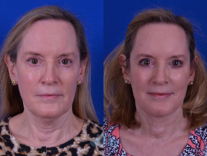 Facelift & Necklift - Before
