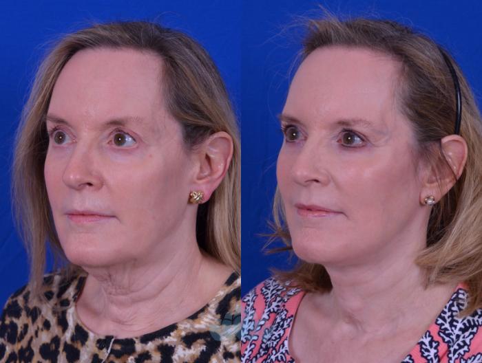 Facelift & Necklift - Before