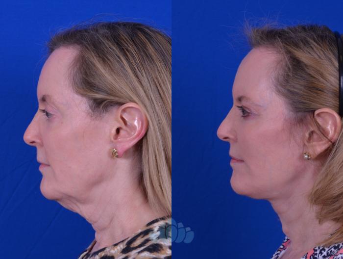 Facelift & Necklift - Before