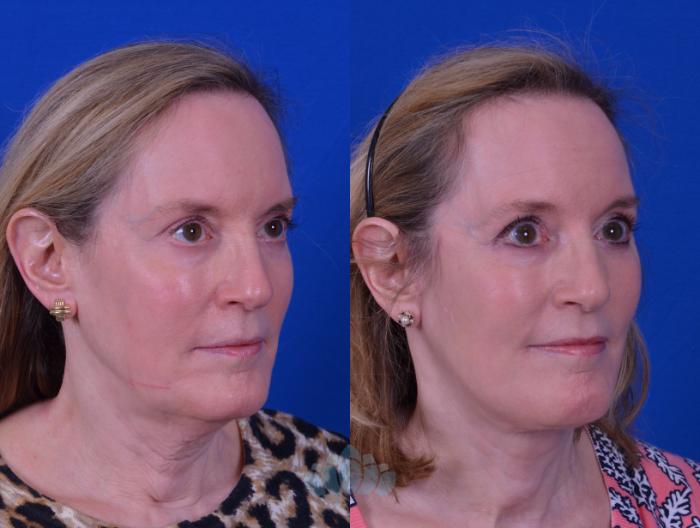 Facelift & Necklift - Before