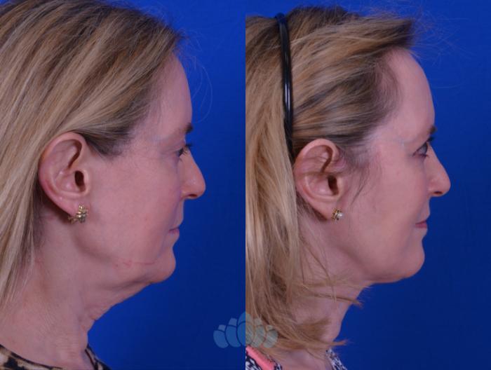 Facelift & Necklift - Before