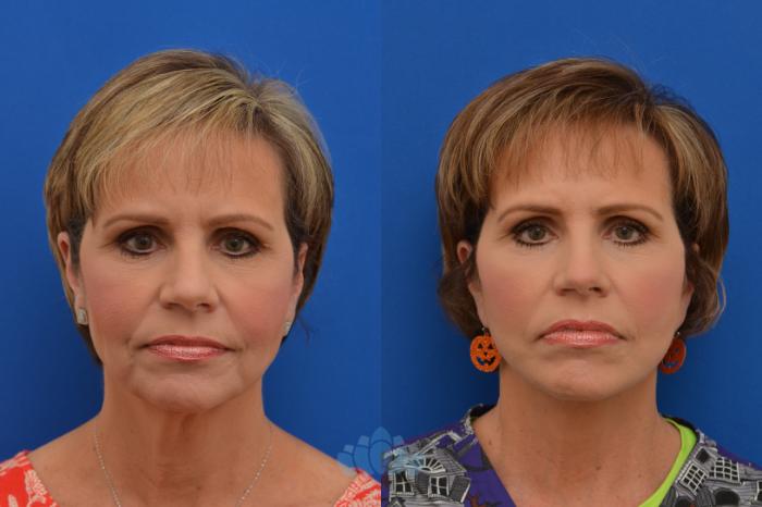 Deep Plane Facelift - Before