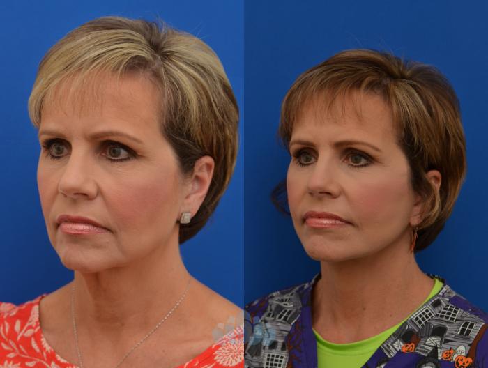 Deep Plane Facelift - Before