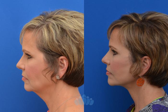 Deep Plane Facelift - Before