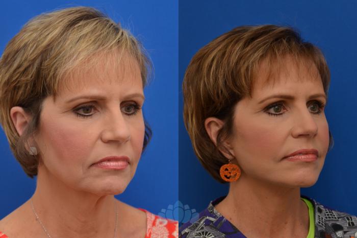 Deep Plane Facelift - Before