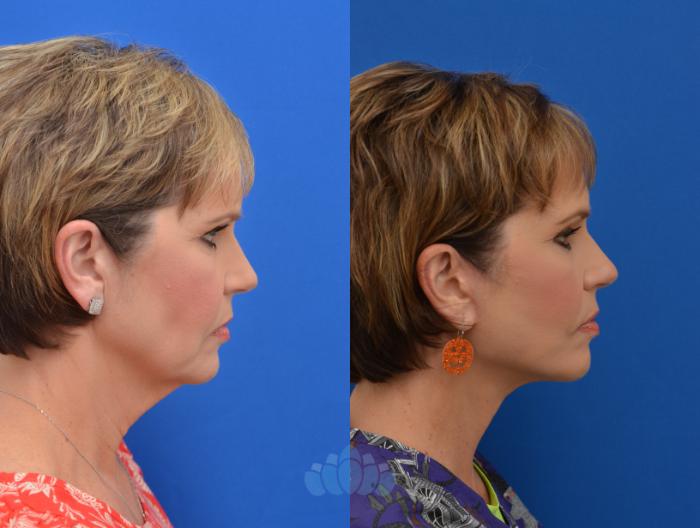 Deep Plane Facelift - Before