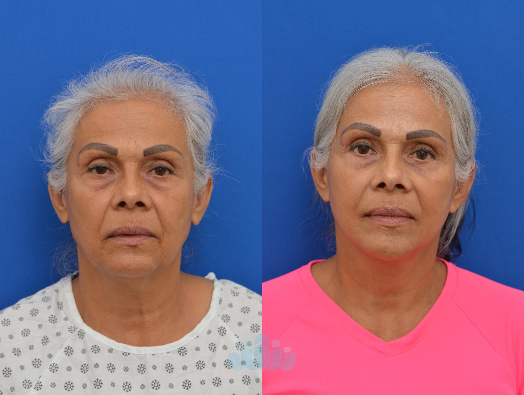 Deep Plane Facelift, Bilateral Upper Blepharoplasty, Bilateral Lower Blepharoplasty - Before