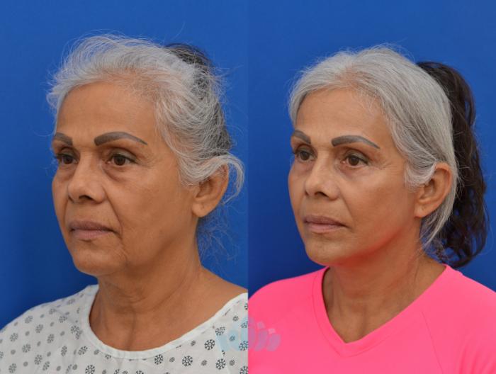Deep Plane Facelift, Bilateral Upper Blepharoplasty, Bilateral Lower Blepharoplasty - Before