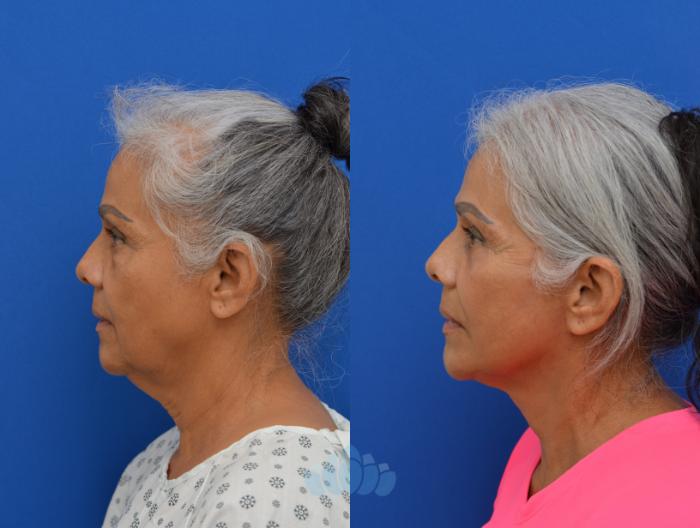 Deep Plane Facelift, Bilateral Upper Blepharoplasty, Bilateral Lower Blepharoplasty - Before