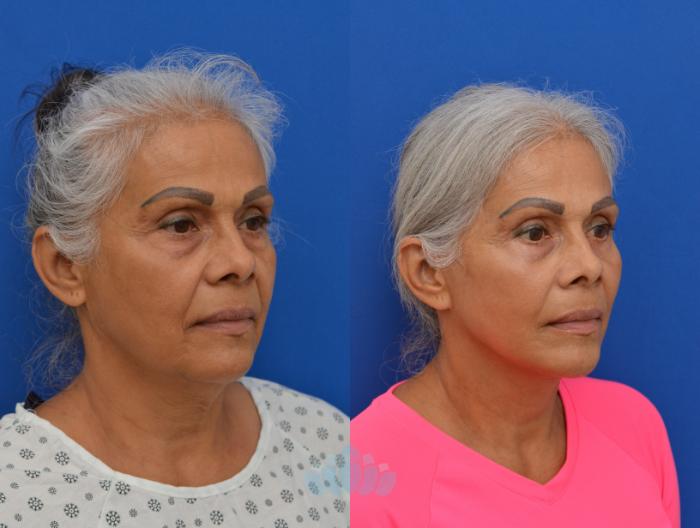 Deep Plane Facelift, Bilateral Upper Blepharoplasty, Bilateral Lower Blepharoplasty - Before