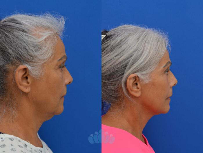 Deep Plane Facelift, Bilateral Upper Blepharoplasty, Bilateral Lower Blepharoplasty - Before