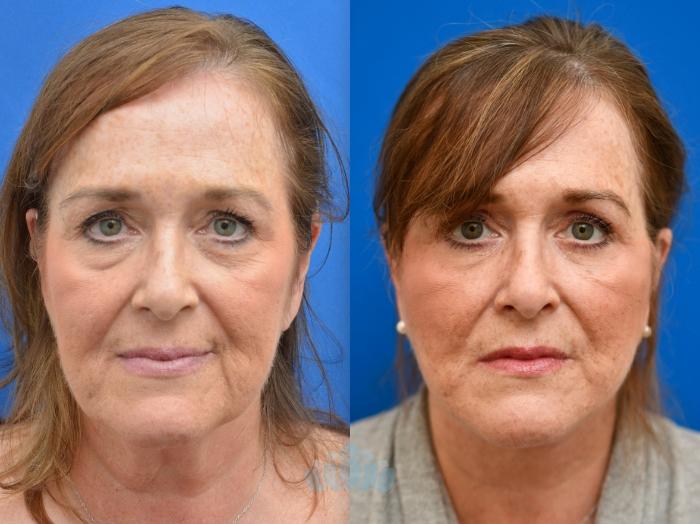 Deep Plane Facelift, Bilateral Upper Blepharoplasty, Bilateral Lower Blepharoplasty - Before