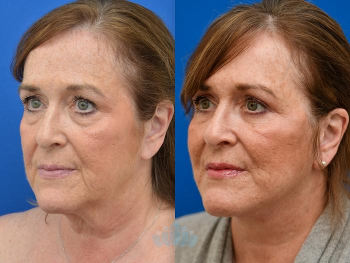 Deep Plane Facelift, Bilateral Upper Blepharoplasty, Bilateral Lower Blepharoplasty - Before