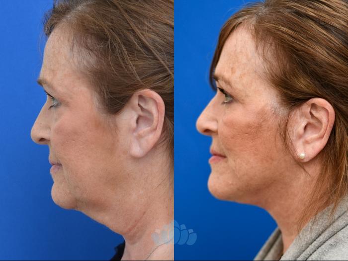 Deep Plane Facelift, Bilateral Upper Blepharoplasty, Bilateral Lower Blepharoplasty - Before