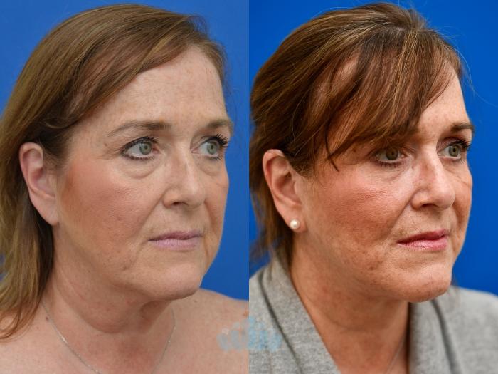 Deep Plane Facelift, Bilateral Upper Blepharoplasty, Bilateral Lower Blepharoplasty - Before