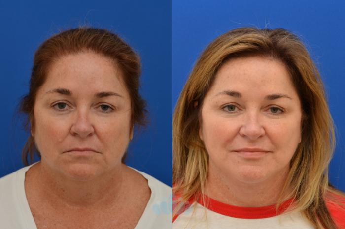 Deep Plane Facelift - Before