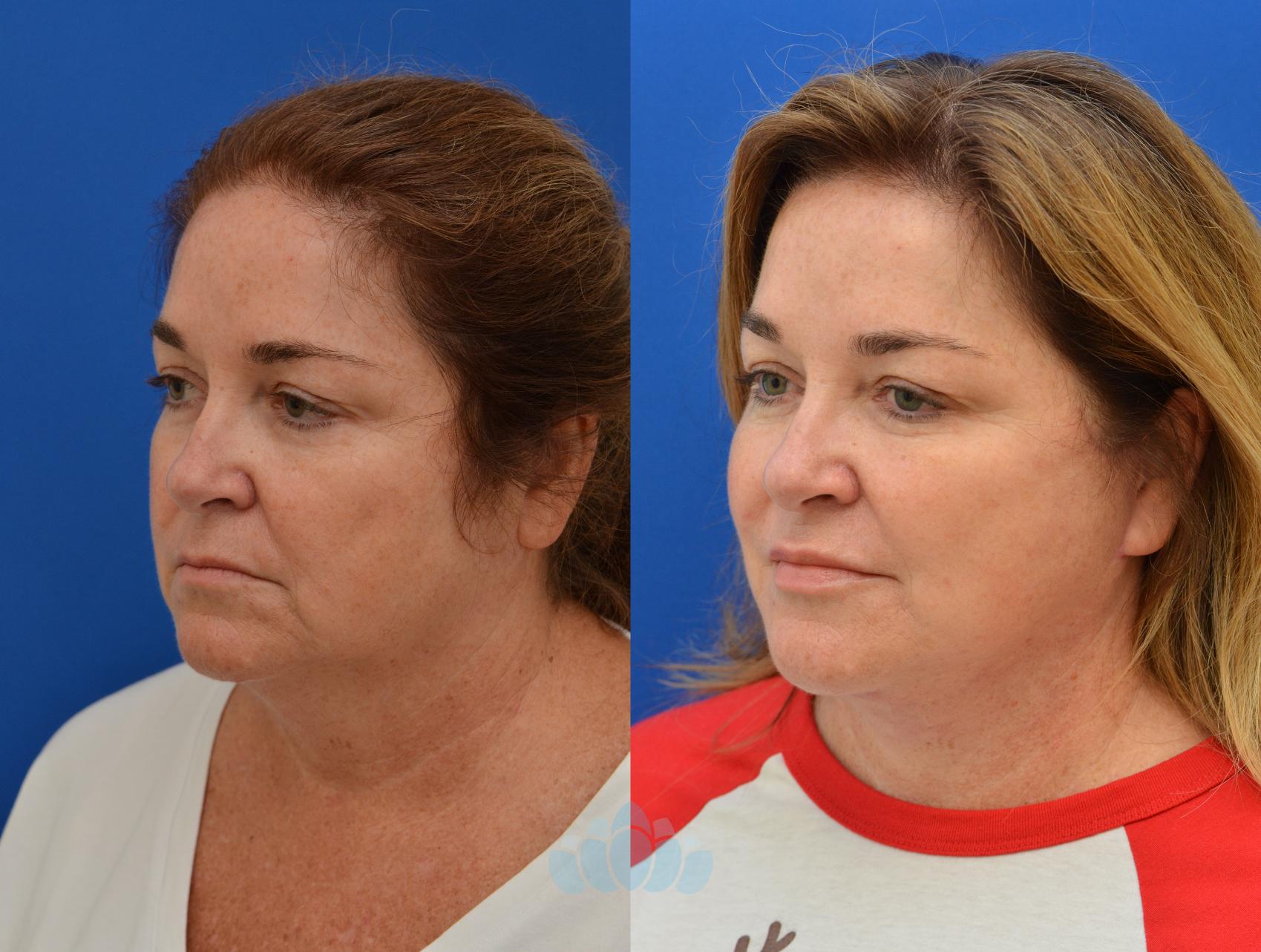 Deep Plane Facelift - Before