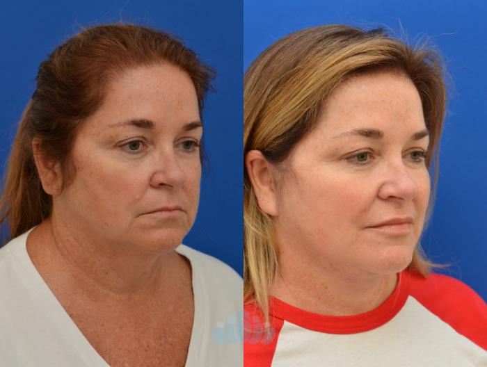 Deep Plane Facelift - Before
