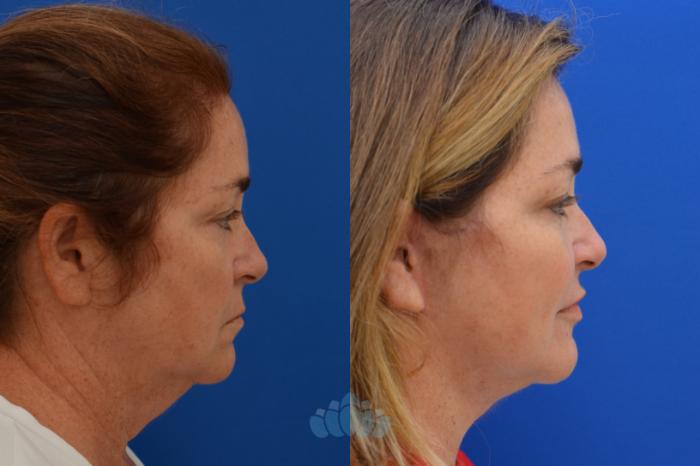 Deep Plane Facelift - Before