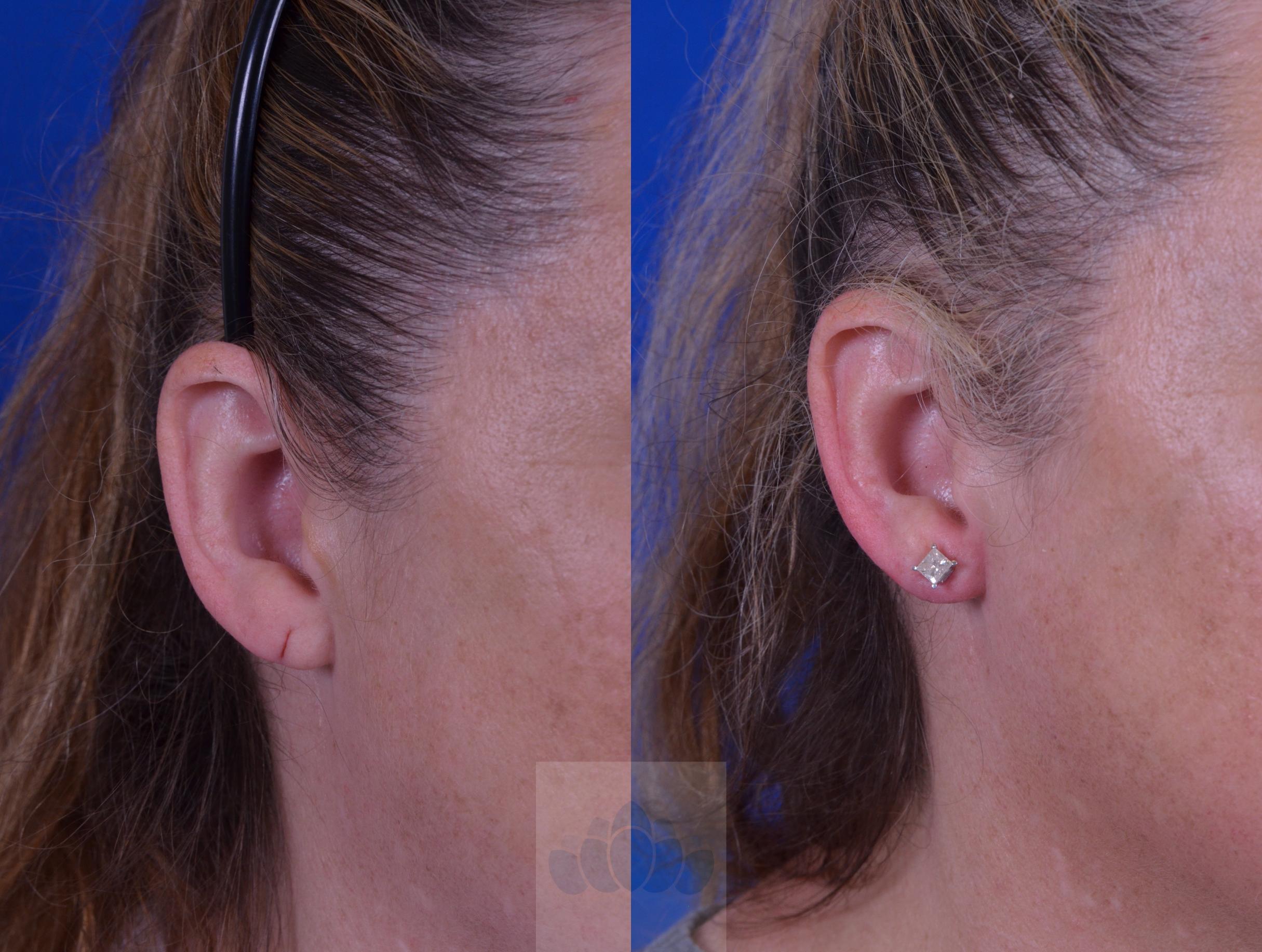 Before & After Ear Surgery Case 9 Right Side View in Charlotte, NC