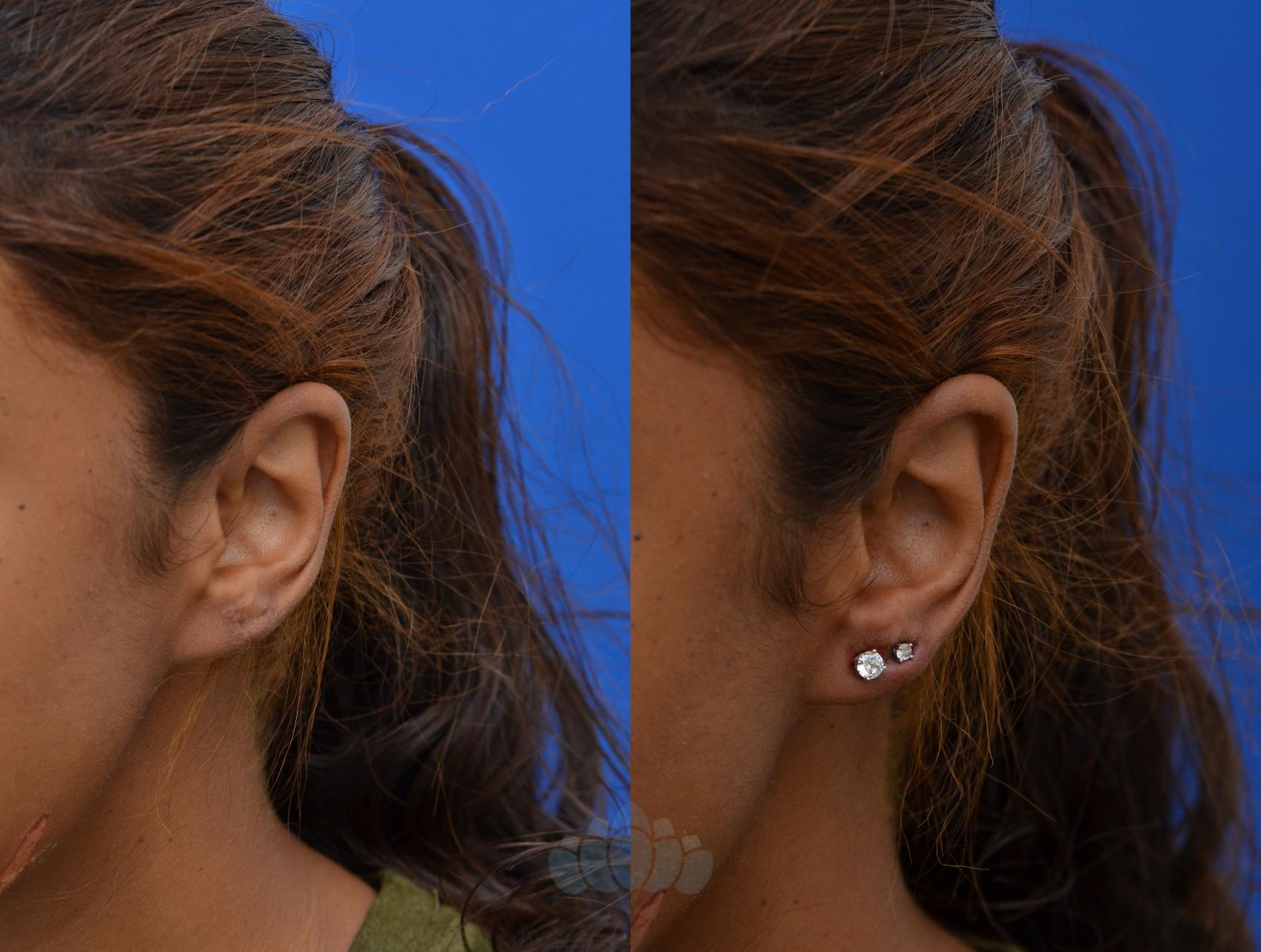 Before & After Earlobe Repair  Case 10 Left Side View in Charlotte, NC