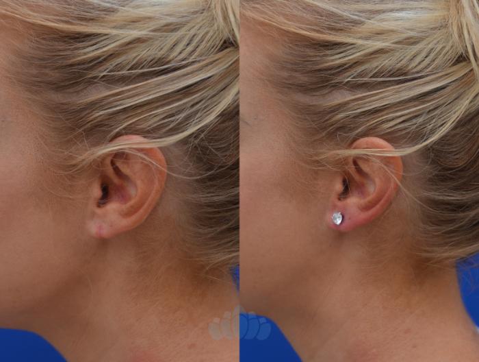 Earlobe Repair - Left Side - Before Re-Piercing 