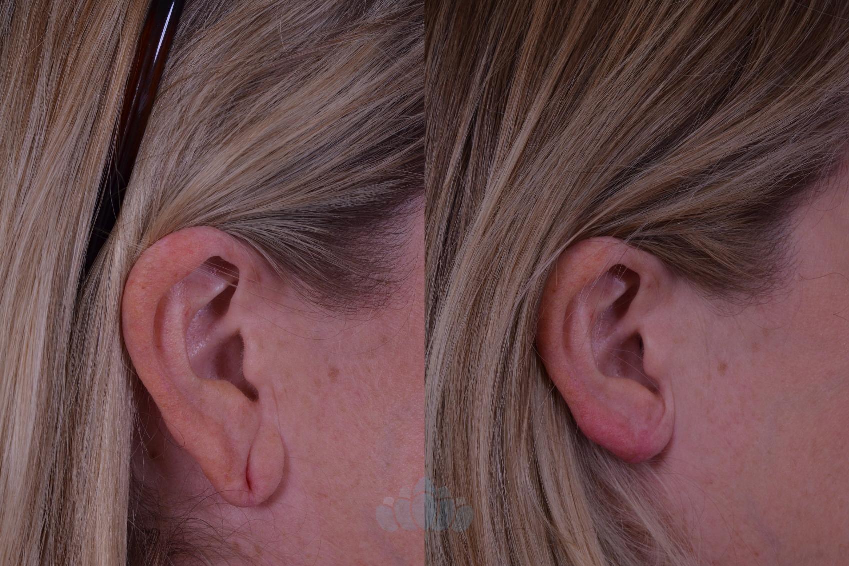Earlobe Repair Before And After Pictures Case 58 Charlotte Nc