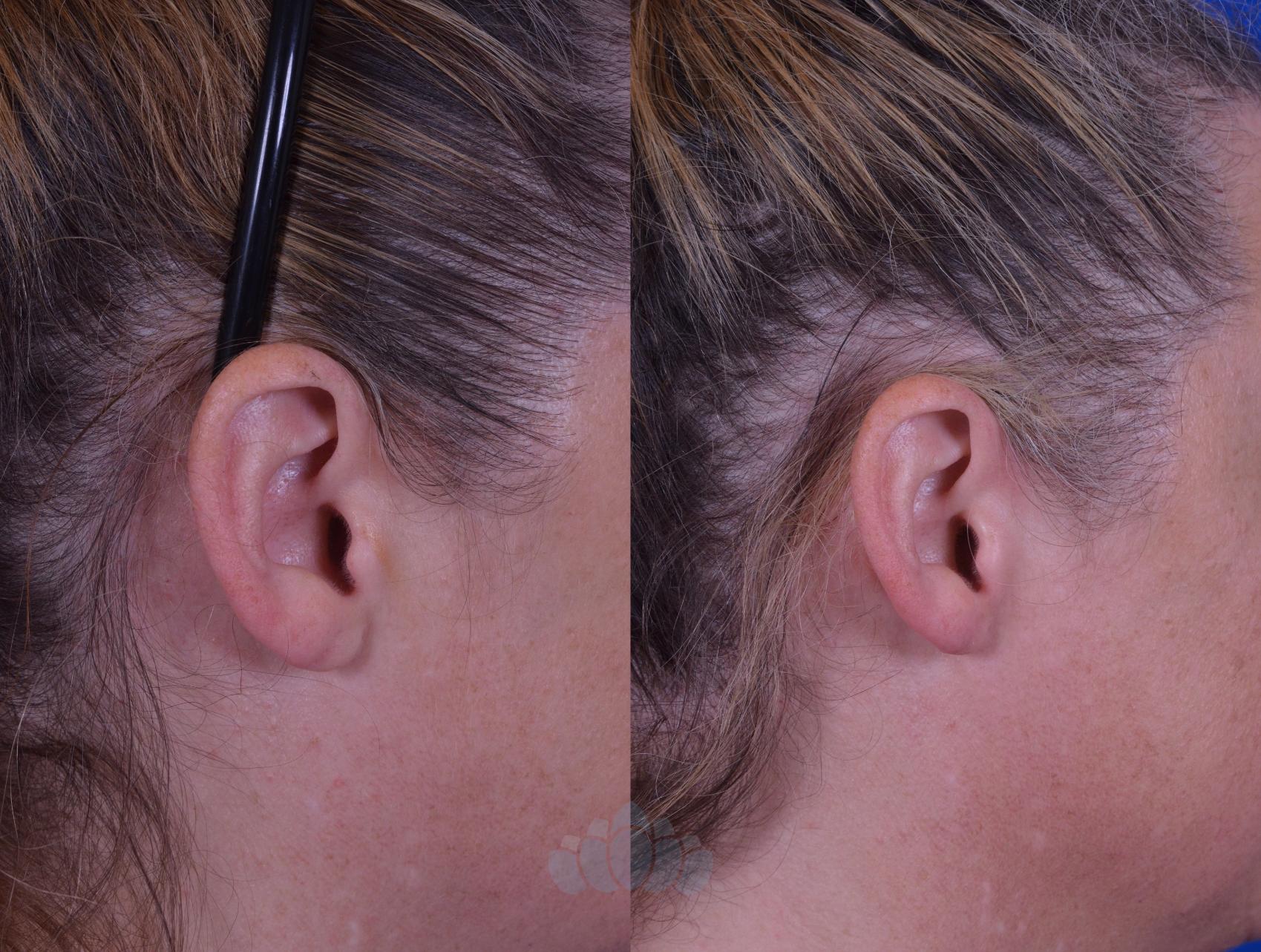 Earlobe Repair Before And After Pictures Case 83 Charlotte Nc Dilworth Facial Plastic Surgery 5460